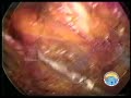 Hernia TAPP