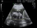 Ecografia 4D Uxue