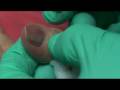 videos de Ganglion Cyst Drainage