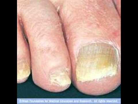 how to cure yellow nails