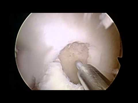 how to repair knee cartilage