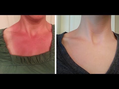 how to recover sunburn