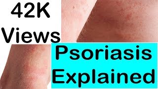 Psoriasis Causes- Psoriasis Natural Treatment