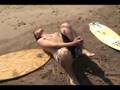 Skimboard broken ankle