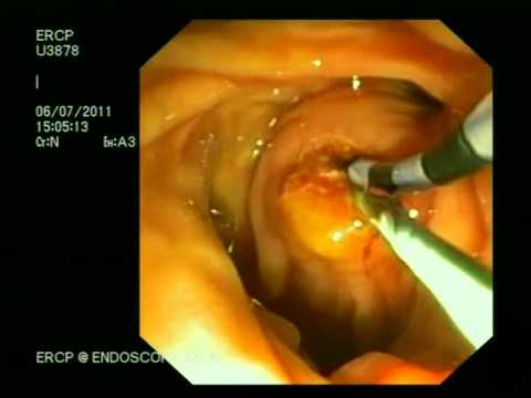how to treat obstructive jaundice