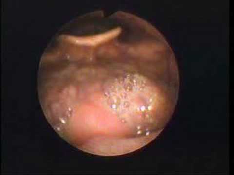Narrated Self-Nasoendoscopy
