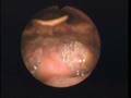 Narrated Self-Nasoendoscopy