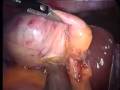 SILS Cholecystectomy