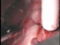 BIOLASE Cyst Removal.wmv