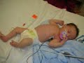Birth Injuries