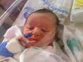 Birth Injuries