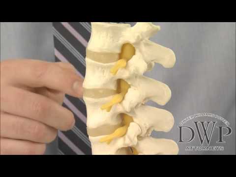 Annular Tear Injuries in Oregon Auto and Other Serious Accidents