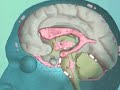Causes of Normal Pressure Hydrocephalus Hydrocephalus