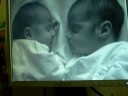 Twins,mellizos,gemelos,el Lic Norberto Litvinoff relaciona esta caracteristica con la ´´posible´´emergencia de sintomas sexuales,dados el contacto intimo de ambos en el periodo gestacional en el seno materno y mas que nada en lo traumatico de la separacion...del parto.Esta sugerente idea tiene su correlato en profundas y modificadoras tecnicas de curacion de estas disfunciones sexuales.Esto lo deberian ver todos los mellizos y cualquier persona afectada de una eyaculacion precoz.Aguardo tu aporte amigo.