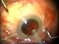 cataract surgery