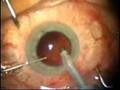 Cataract surgery