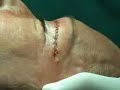Blepharoplasty laser technique Blepharoplasty laser technique