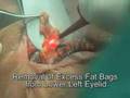 Blepharoplasty laser technique