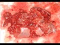 Laparoscopic Spleen Surgery (Laparoskopik Dalak Cerrahisi) Laparoscopic Spleen Surgery (Laparoskopik Dalak Cerrahisi)