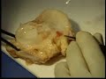 Biologic Joint Replacement: Meniscus Transplantation