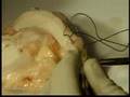 Biologic Joint Replacement: Meniscus Transplantation