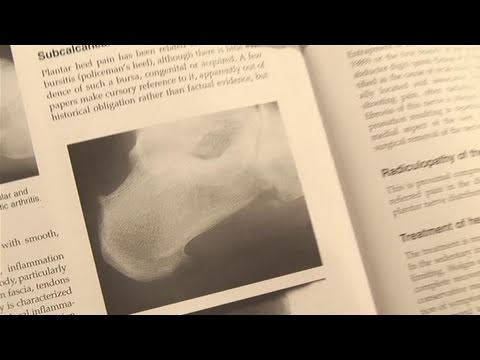 how to eliminate bone spurs