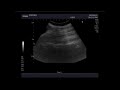 Obstructive uropathy