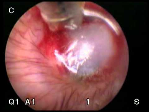 how to drain otitis media