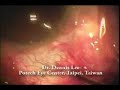 Shallow Chamber cataract surgery