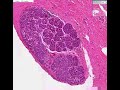 Histopathology Breast--Lobular carcinoma in situ