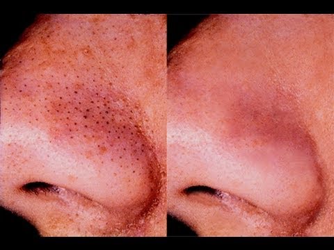 how to eliminate nose blackheads