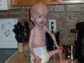 Zachary Moore old at 3 Progeria