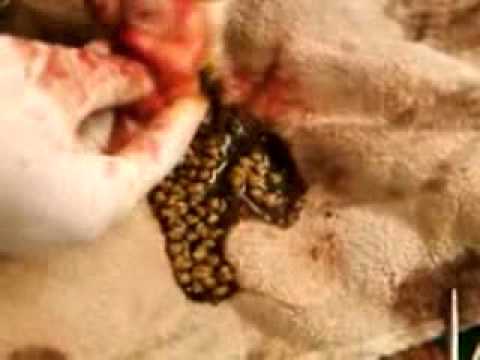 how to dissolve abdominal adhesions