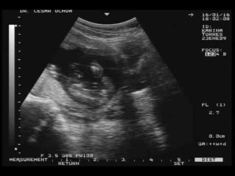 Ultrasonidos de 3 semanas de embarazo en 3D - Imagui Ultrasonidos de 3 semanas de embarazo en 3D - Imagui