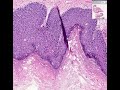 Histopathology Penis--Carcinoma in situ