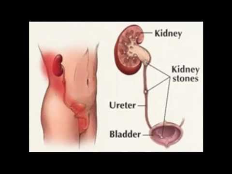 how to dissolve cystine kidney stones