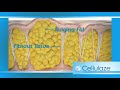 Dr. Sean Rice - Cellulaze - Rice Cosmetic Surgery
