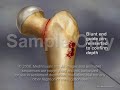 Revision Femoral Neck Fracture (pediatric)