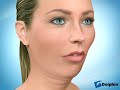 Lower Jaw Advancement Surgery