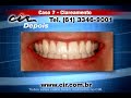 Clareamento dental