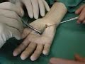Carpal tunnel syndrome minimally invasive surgery