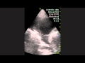 Aorta Aorta