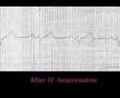 Temporary medical pacing