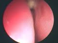 Severe Nasal Mucosal Edema
