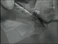TUNANTE LOBOSK8 OPERACI�N
