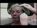 Fraxel Laser for Acne Scarring