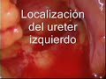 RESECCION ANTERIOR TRAS COLOSTOMIA SOBRE VARILLA