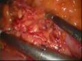 RESECCION ANTERIOR TRAS COLOSTOMIA SOBRE VARILLA