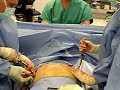 Nuss Procedure Video #1