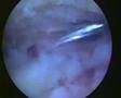 Acromioplasty for the shoulder impingement syndrome.